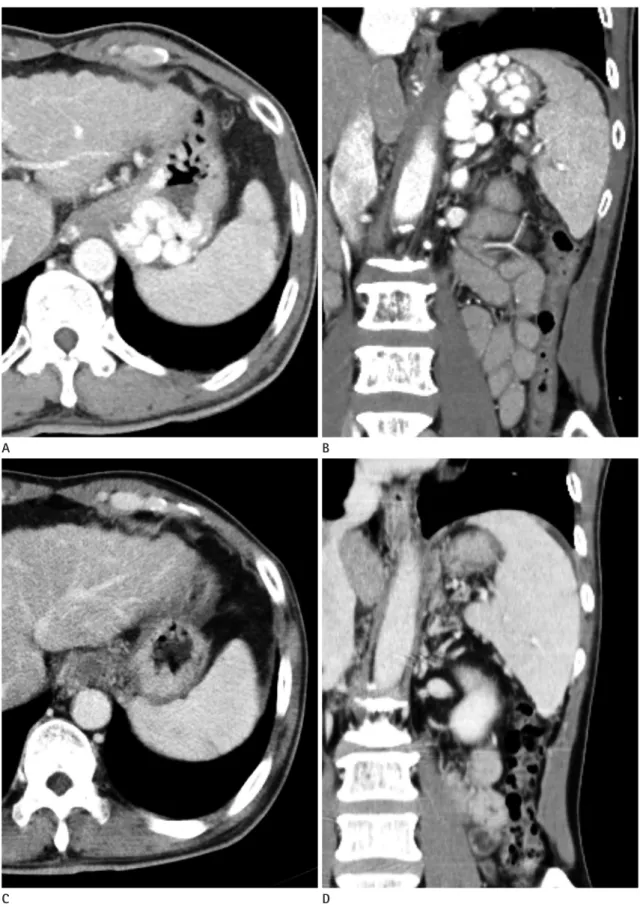 Fig. 4. Pre- and postprocedural CT images of PARTO (the same patient as in Figs. 2 and 3).