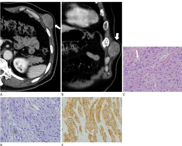 Fig. 1. A 66-year-old man with a malignant granular cell tumor of the abdominal wall muscle.