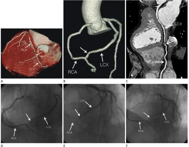 Fig. 1. Communication between the right and circumflex coronary arteries discovered incidentally by multidetector computed tomography.