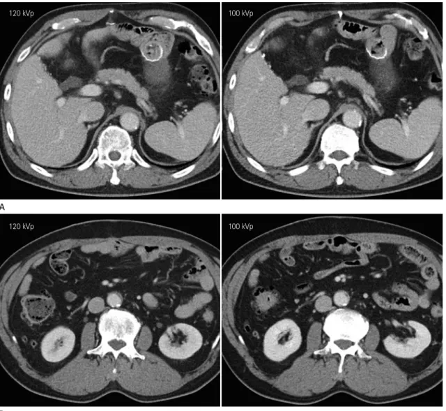 Fig. 6. A 59-year-old male patient underwent gastrectomy of the gastric cancer with post-operative follow-up CT scans using 120 kVp (DLP, 631  mGy·cm) and 100 kVp (DLP, 567 mGy·cm) (window width/level, 45/400) tube voltage at 6-month intervals