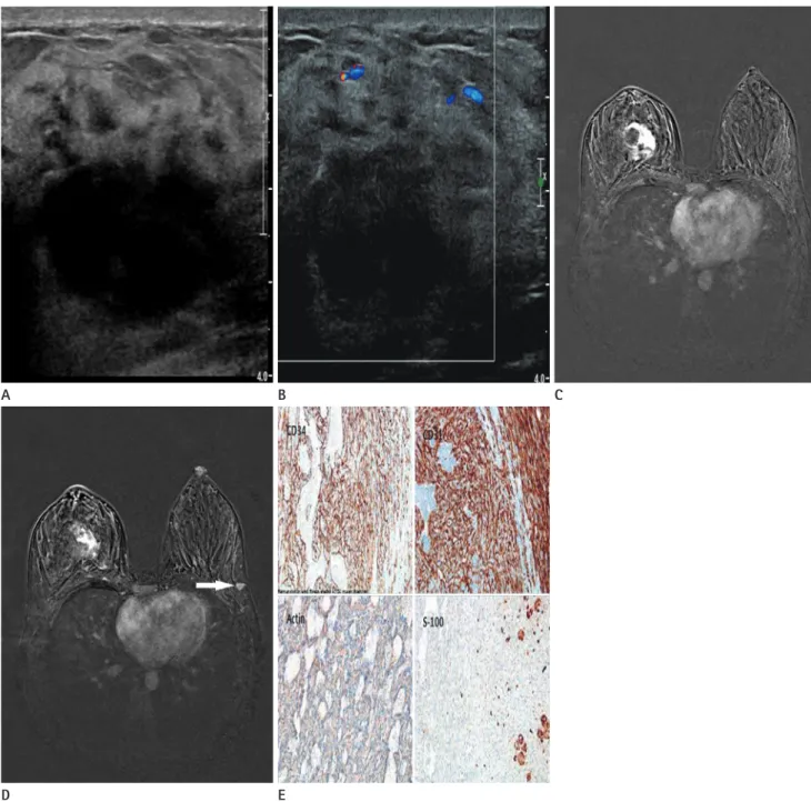 Fig. 1. A 34-year-old woman with primary bilateral angiosarcoma of the breast presenting with a palpable mass in the right breast.