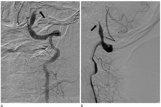 Fig. 1. Digital subtraction angiography of left vertebral artery. 