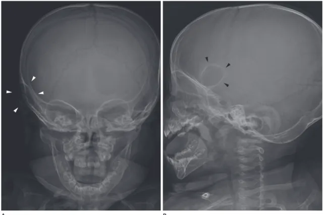 Fig. 1. The AP (A) and lateral (B) radiographs of the skull demonstrate a well-defined expansile osteolytic lesion with a thin sclerotic rim in the  right temporal bone (arrowheads).