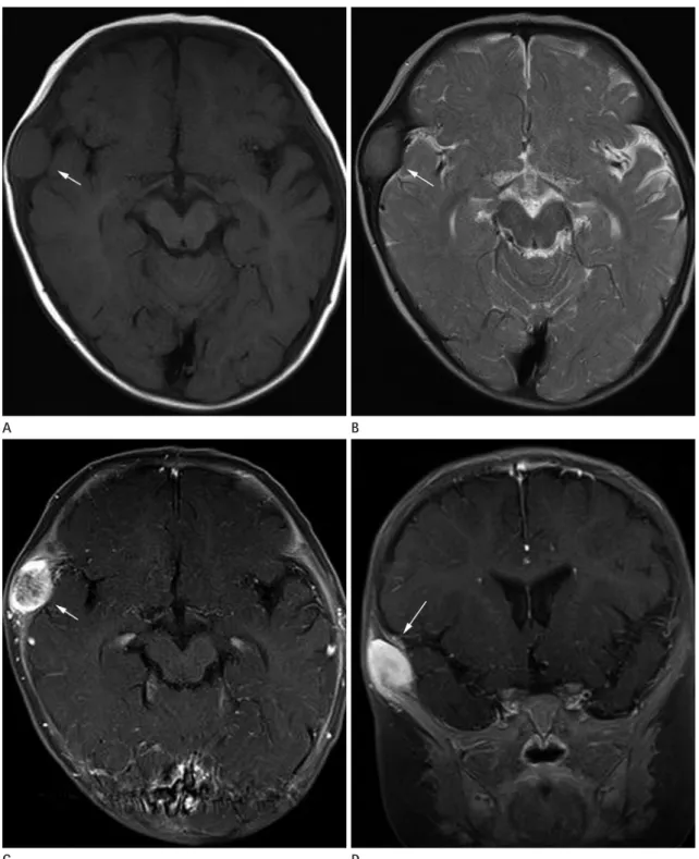 Fig. 2. MR images of solitary infantile myofibromatosis of the skull (arrows). 