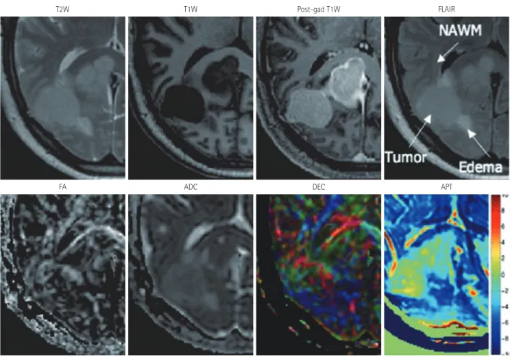 Fig. 3. For a patient with a meningioma, the APT image can be compared with different types of MR images, such as T2-weighted (T2W), T1- T1-weighted (T1W), fractional anisotropy (FA), apparent diffusion coefficient (ADC), and directionally-encoded color (D