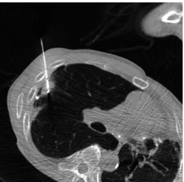 Fig. 1. Chest CT with lung window reveals a 1.5 cm sized spiculated  nodule with an air bronchogram in the right upper lobe