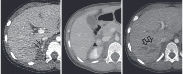 Fig. 1. Contrast-enhanced computed tomography demonstrating a retroperitoneal hematoma with contrast extravasation into the right adrenal  gland (solid arrows), segmental renal infarction in the right kidney (arrowhead), and multifocal liver lacerations (o