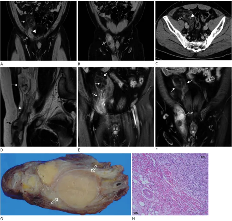 Fig. 1. A 37-year-old male with a retroperitoneal dedifferentiated liposarcoma (DDL) extending into the right inguinal canal.