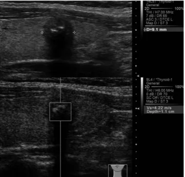 Fig. 1. Solid, marked hypoechoic nodule with calcification shows high  VTQ score (4.22 m/s)
