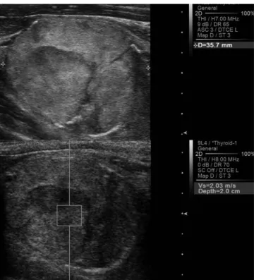 Fig. 5. Hypoechoic solid nodule with macrocalcification shows high  VTQ value (4.71 m/s) in ARFI evaluation