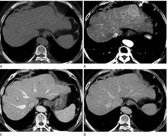 Fig. 1. Hepatic MALT lymphoma in a 71-year-old woman on CT. 