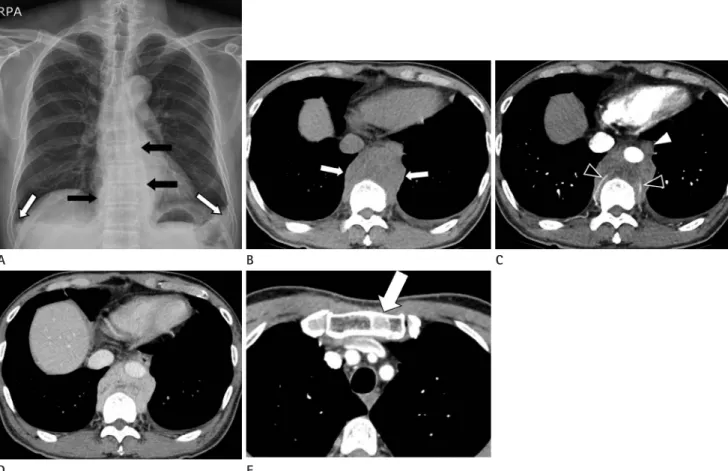 Fig. 1. Plain radiograph and chest CT scan in 67-year-old man with multiple solitary plasmacytomas.