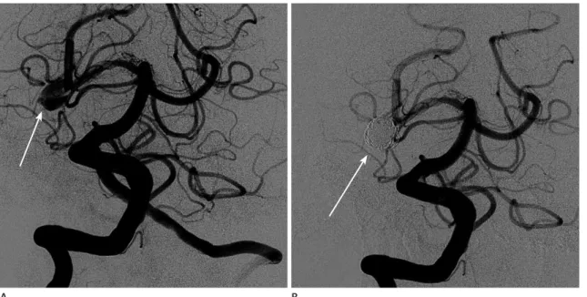 Fig. 2. A saccular dissecting aneurysm at the right P2 segment in a 61-year-old female patient who presented with headache (patient number 3  in Table 1).