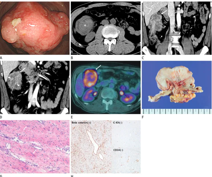 Fig. 1. A 47-year-old man presented with mesenteric fibromatosis at the ascending mesocolon forming colo-colic intussusception and mimick- mimick-ing malignant tumors.