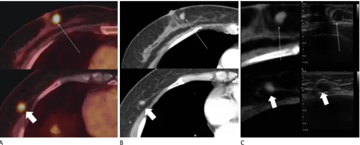 Fig. 1. Imaging findings of metastatic tumors in the right breast from thyroid carcinoma in a 72-year-old woman, 6 years after initial thyroidectomy