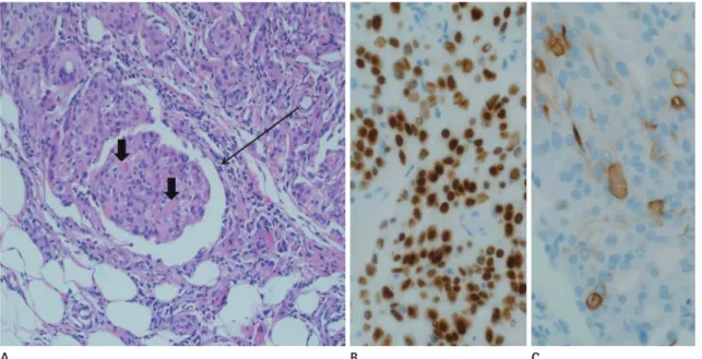 Fig. 2. Pathologic findings of metastatic tumors in the right breast from thyroid carcinoma in a 72-year-old woman, 6 years after initial thyroid- thyroid-ectomy