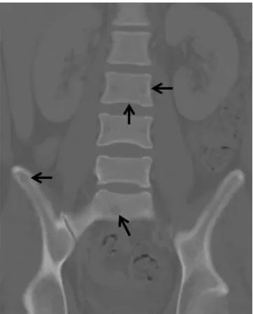 Fig. 2. T1-weighted, T2-weighted, and gadolinium-enhanced T1-weighted fat-saturated sagittal lubar spine MRI images.