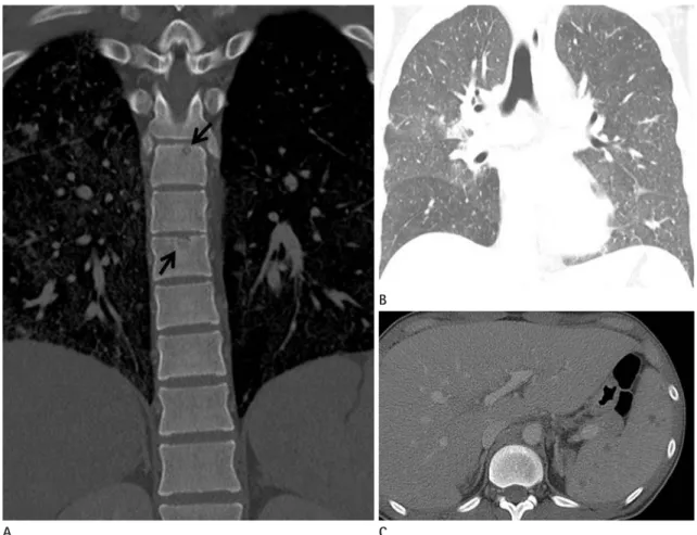 Fig. 4. Miliary tuberculosis on follow-up chest CT after 2 months.