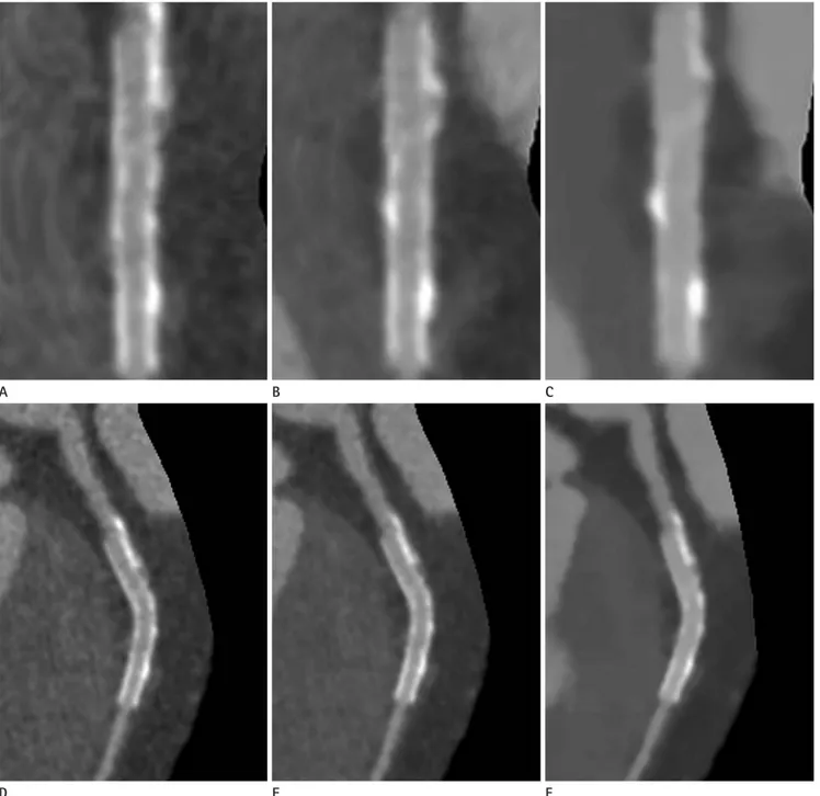 Fig. 3. Straight view of curved MPR images with FBP (A), ASIR (B), and MBIR (C) technique