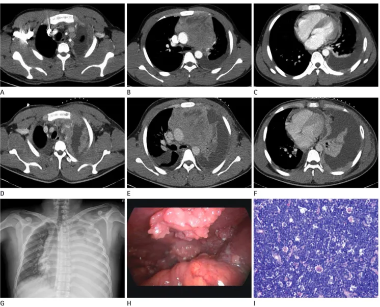 Fig. 1. A 26-year-old man with mediastinal T-cell lymphoblastic lymphoma.