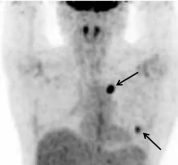 Fig. 2. Ultrasonography (US) performed 6 months after video-assisted thoracic surgery (VATS) resection for evaluation of a palpable mass in the  left breast.
