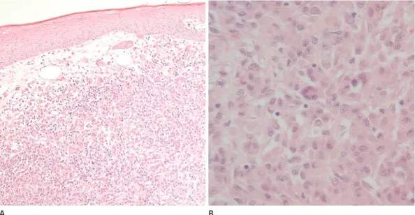 Fig. 3. Microscopic images of the specimen showing foamy histiocytes, Touton giant cells, lymphocytes, and a few eosinophils, consistent with  the characteristics of xanthogranuloma; hematoxylin and eosin, × 100 (A) and × 400 (B)