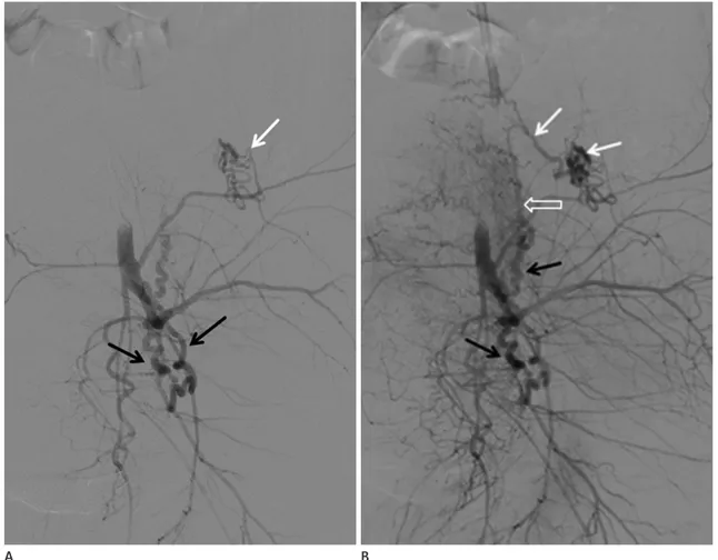 Fig. 1. Left internal iliac arteriogram shows hypertrophied left uterine arteries (black arrows) and an aberrant left ovarian artery originating from  the left iliolumbar artery (white arrow) (A)