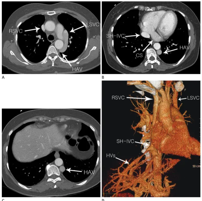 Fig. 1. Axial (A-C) and three-dimensional computed tomography (D) images showing an absent hepatic segment of the inferior vena cava (IVC)  with hemiazygos continuation