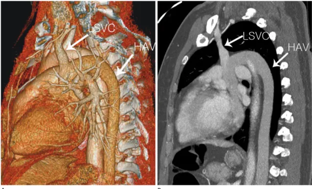 Fig. 2. Three-dimensional volume-rendering (A) and oblique sagittal maximum intensity (B) images showing the dilated hemiazygos vein (HAV)  draining into the LSVC.