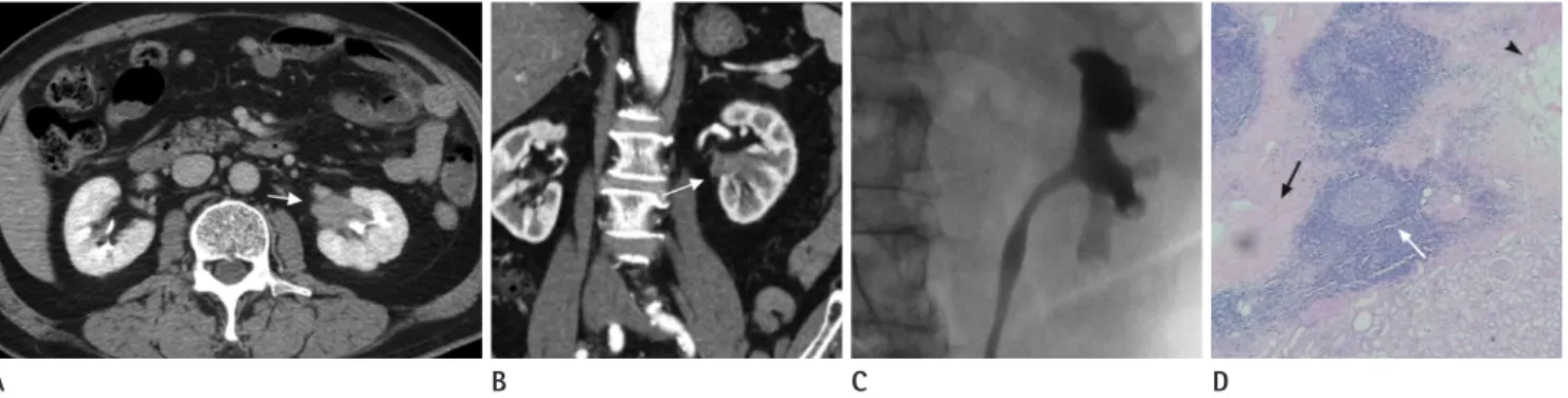 Fig. 2. An 80-year-old man with the incidental finding of a left renal pelvic mass-like lesion.