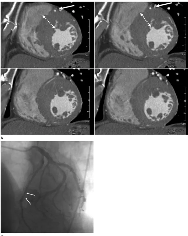 Fig. 2. A 55-year-old male with hypertrophic cardiomyopathy. 