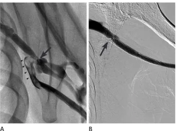 Fig. 1. A 68-year-old man with a dysfunctional arteriovenous graft. 