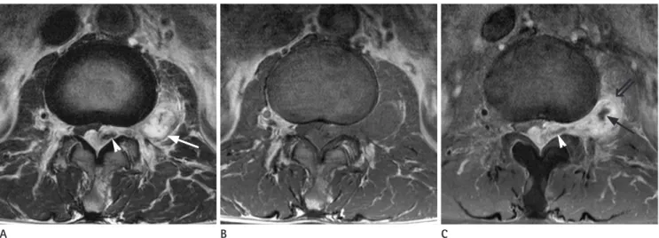Fig. 1. Lumbar MRI of a 54-year-old man presenting lower extremity weakness. A Dumbbell-shaped mass involving both epidural and paraspinal  space is noted