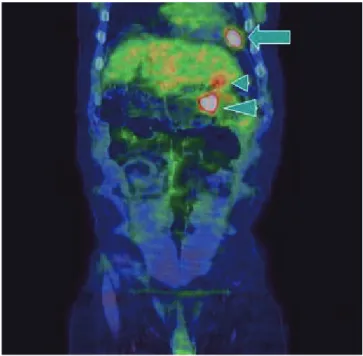 Fig. 2. Follow-up abdominal CT after transarterial chemoembolization  shows homogenous lipiodol uptake (arrow)