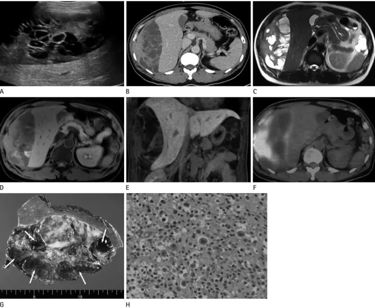 Fig. 1. A 44-year-old man presented with primary perihepatic undifferentiated high-grade pleomorphic sarcoma.