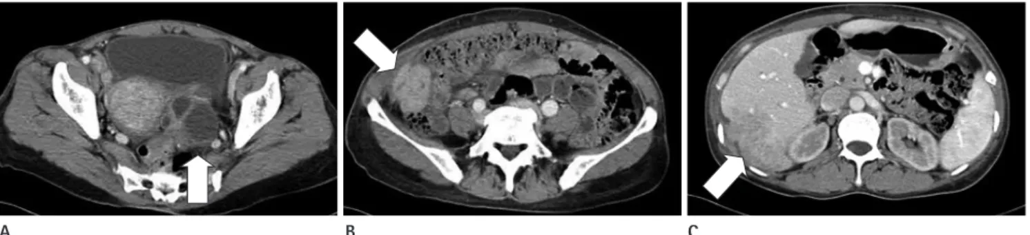 Fig. 2. Serial abdominal CT scan shows bilateral tubo-ovarian abscesses (A, arrow) with PID and a well-enhanced mass (B, arrow) in the right  paracolic gutter