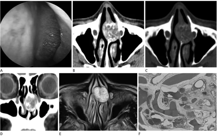 Fig. 1. Intraosseous hemangioma of the nasal septum. 