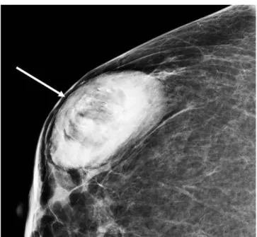 Fig. 2. Ultrasonography findings of infarcted hyperplastic breast tissue. 