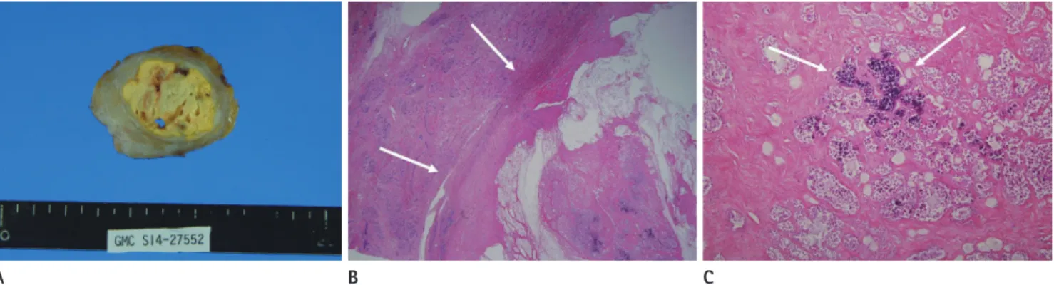 Fig. 3. Histopathology of infarcted hyperplastic breast tissue. 