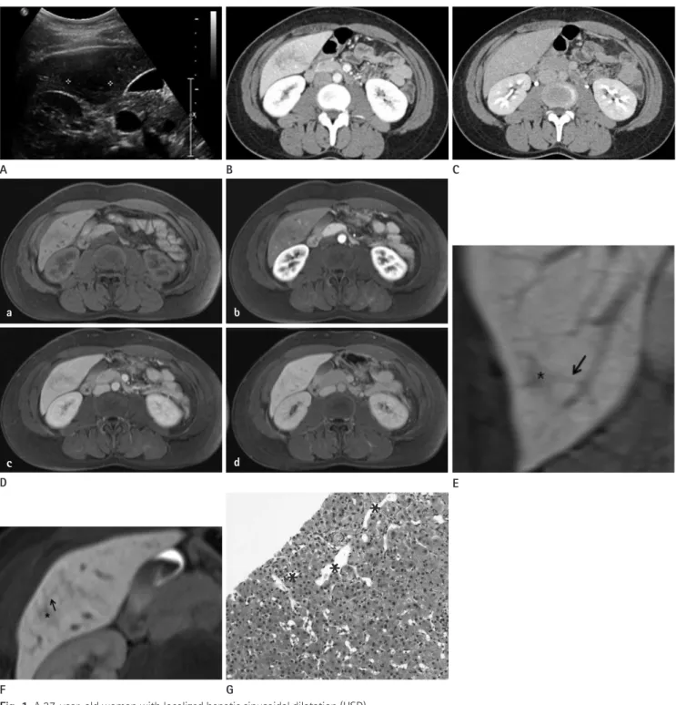 Fig. 1. A 37-year-old woman with localized hepatic sinusoidal dilatation (HSD). 