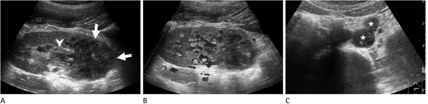 Fig. 1. Ultrasonography of a 12-year-old boy presented with recurrent abdominal pain and vomiting.