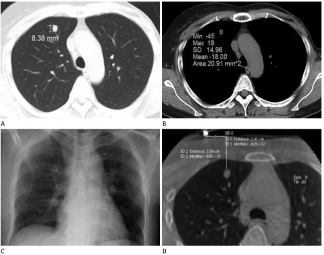 Fig. 1. A small pulmonary nodule in the right upper lobe of a 47-year-old woman with history of breast cancer.