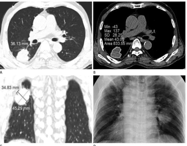 Fig. 2. A solitary pulmonary mass suspicious for malignancy in the right lower lobe of a 72-year-old man, which was well-marginated, irregular- irregular-shaped, and abutting the pleura.