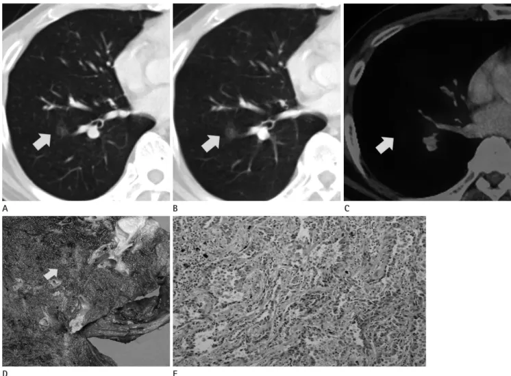 Fig. 2. A ground-glass opacity nodule in the right lower lobe (RLL) lateral basal segment of the lung (lesion 2).