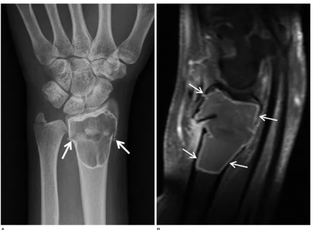 Fig. 1. A 35-year-old female patient with an aneurysmal bone cyst of the distal radius