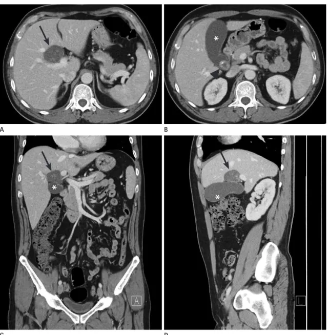 Fig. 1. Axial (A, B), coronal (C), and sagittal (D) views of a contrast-enhanced abdominal CT showing a round cystic lesion (arrow) with multiple  internal calcified stones, at the porta hepatis (just superior to the gallbladder)