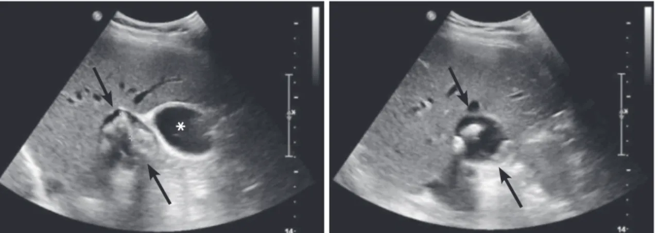 Fig. 2. Abdominal ultrasonography showing a thin-walled cystic lesion (arrows) abutting the gallbladder (asterisk) near the porta hepatis