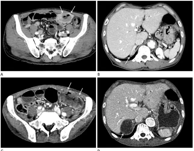 Fig. 1. Primary undifferentiated pleomorphic sarcoma (UPS) of the small bowel with adrenal metastases in a 51-year-old man.