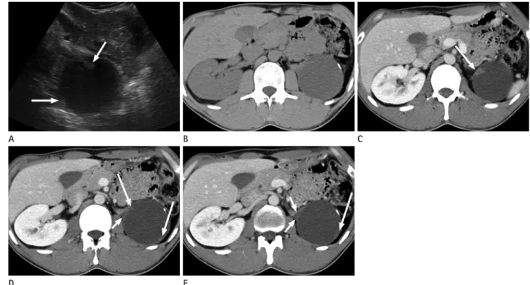Fig. 1. 33-year-old man with a left retroperitoneal mass. 