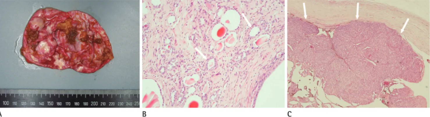 Fig. 2. Histopathologic findings of a surgically resected, left retroperitoneal mass. 